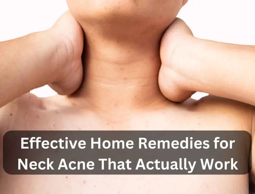 Home Remedies For Neck Acne