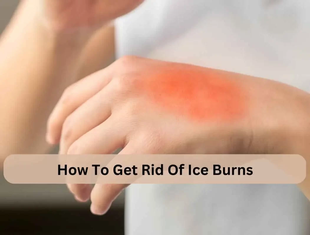 How To Get Rid Of Ice Burns