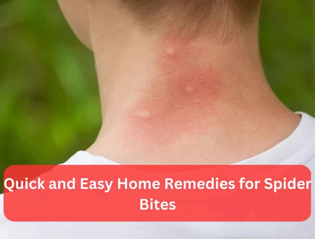 Home Remedies For Spider Bites | saqib.co.in